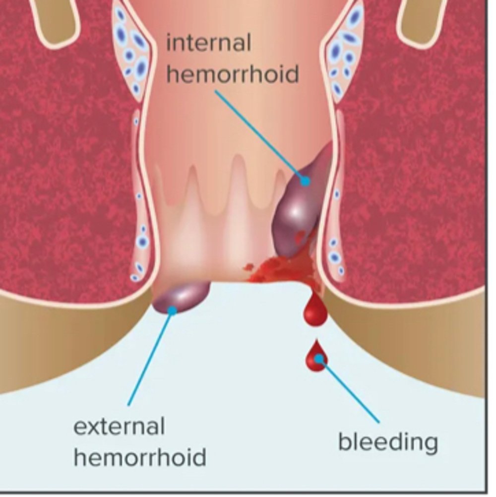 Diagram of internal and eternal hemorrhoids