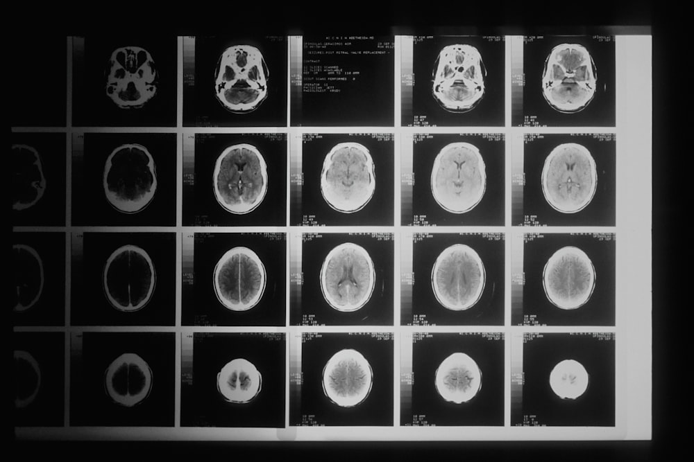 A head x-ray taken by a computer-assisted tomographic (CAT) scanner. This diagnostic technique uses computers to organize thousands of x-rays, taken by a rotating machine around the patient. When first applied in the 1970